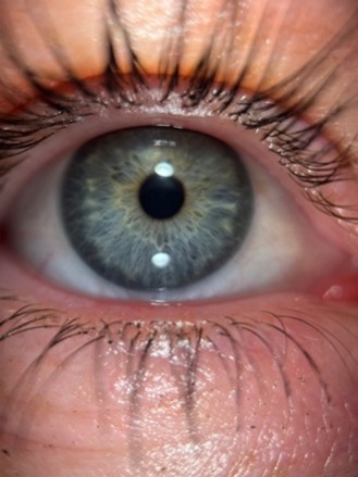 iridologie outil de prevention